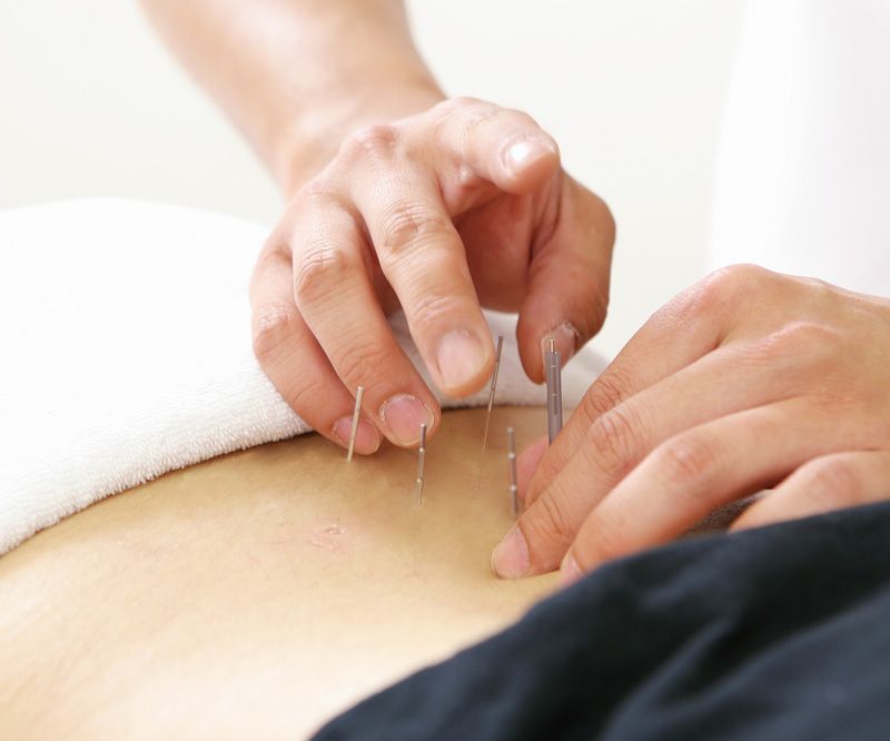 鍼灸施術